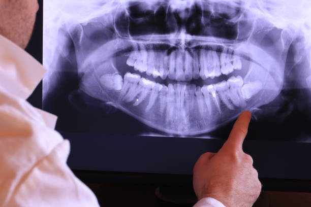 Best Emergency Wisdom Teeth Removal in Brass Castle, NJ