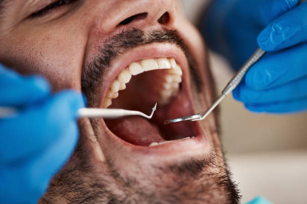 Best Emergency Wisdom Teeth Removal in Brass Castle, NJ